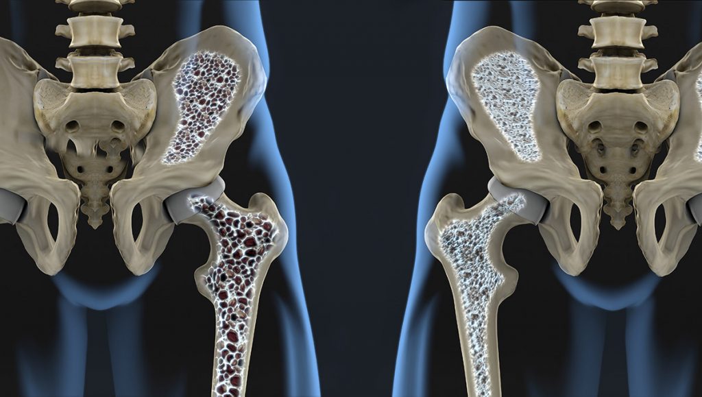 Bone Density, DEXA Scan, Imaging